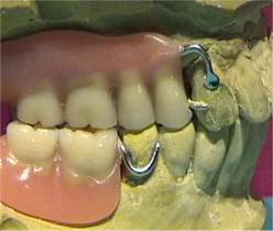 Attacchi Dentali Metallo Incollabili 10 Pulsanti Linguali Ortodontici AZDENT Base Rotonda - Ganci Di Trazione In Metallo MIM, Incollabili Strumenti Odontotecnico - Foto 5